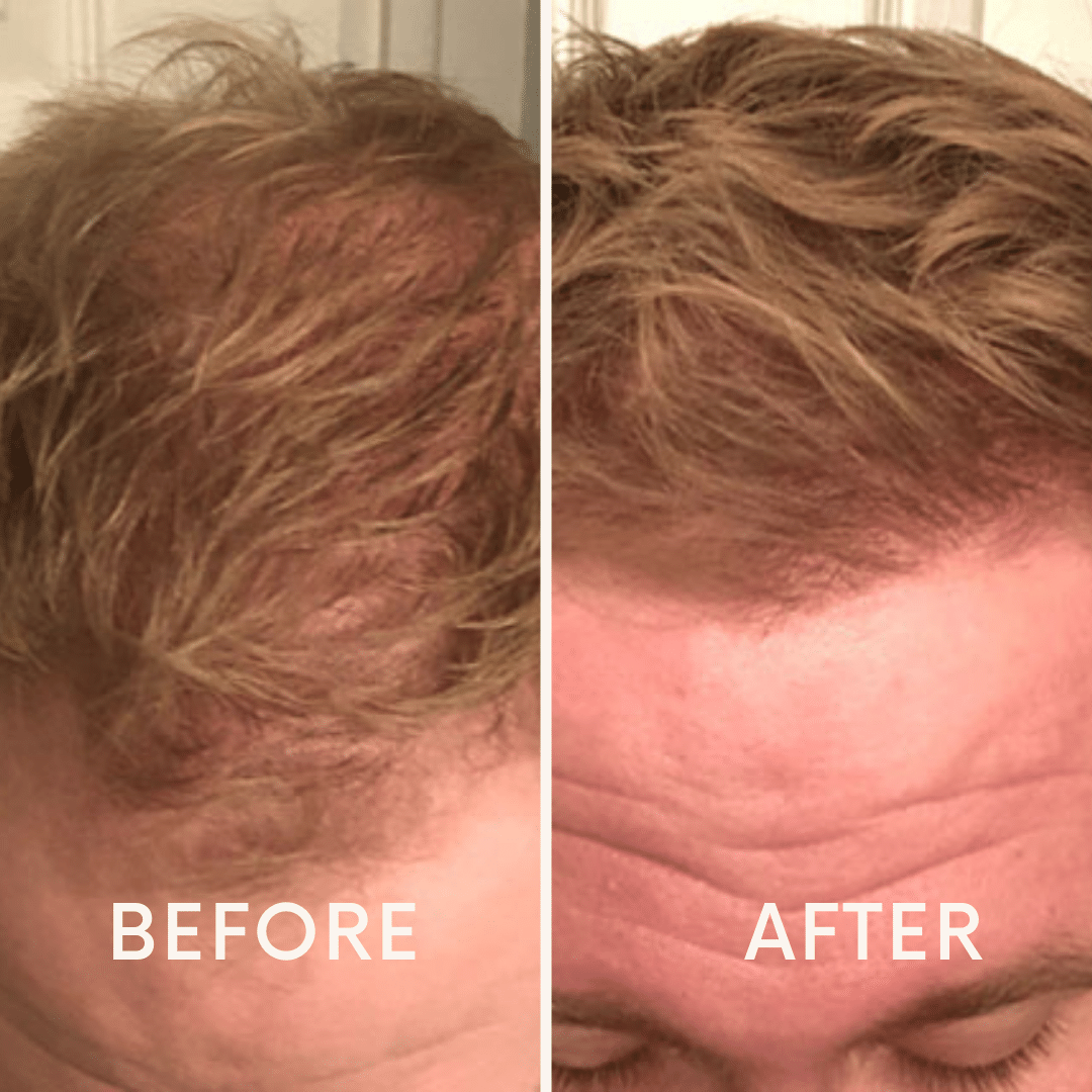 Red Light Therapy Hair Growth Cap